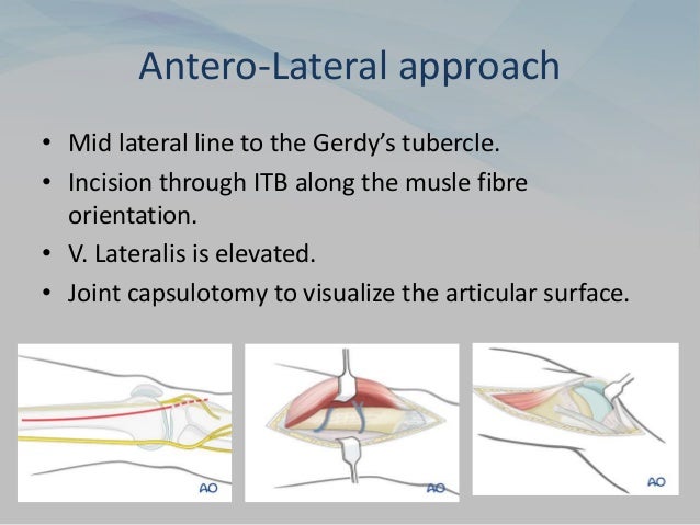 Antero-Lateral approach
• Mid lateral line to the Gerdy’s tubercle.
• Incision through ITB along the musle fibre
orientation.
• V. Lateralis is elevated.
• Joint capsulotomy to visualize the articular surface.
 