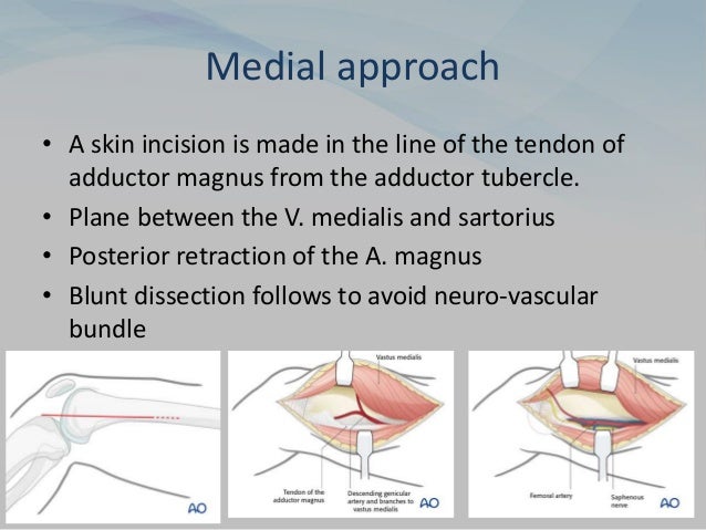 Medial approach
• A skin incision is made in the line of the tendon of
adductor magnus from the adductor tubercle.
• Plane between the V. medialis and sartorius
• Posterior retraction of the A. magnus
• Blunt dissection follows to avoid neuro-vascular
bundle
 