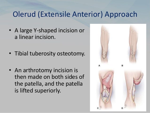 Olerud (Extensile Anterior) Approach
• A large Y-shaped incision or
a linear incision.
• Tibial tuberosity osteotomy.
• An arthrotomy incision is
then made on both sides of
the patella, and the patella
is lifted superiorly.
 