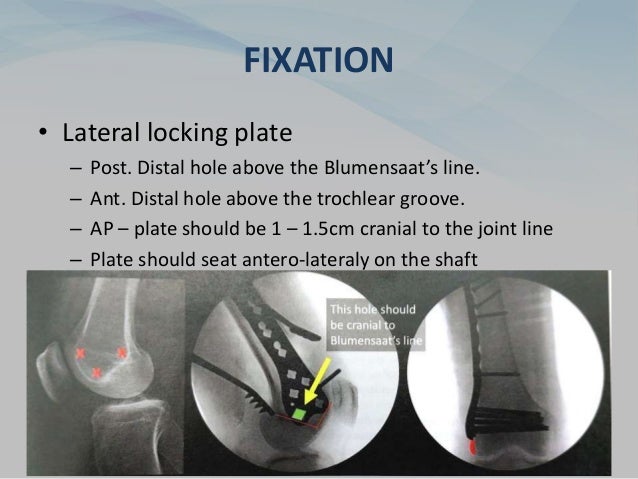 FIXATION
• Lateral locking plate
– Post. Distal hole above the Blumensaat’s line.
– Ant. Distal hole above the trochlear groove.
– AP – plate should be 1 – 1.5cm cranial to the joint line
– Plate should seat antero-lateraly on the shaft
 