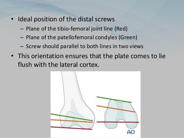 • Ideal position of the distal screws
– Plane of the tibio-femoral joint line (Red)
– Plane of the patellofemoral condyles (Green)
– Screw should parallel to both lines in two views
• This orientation ensures that the plate comes to lie
flush with the lateral cortex.
 