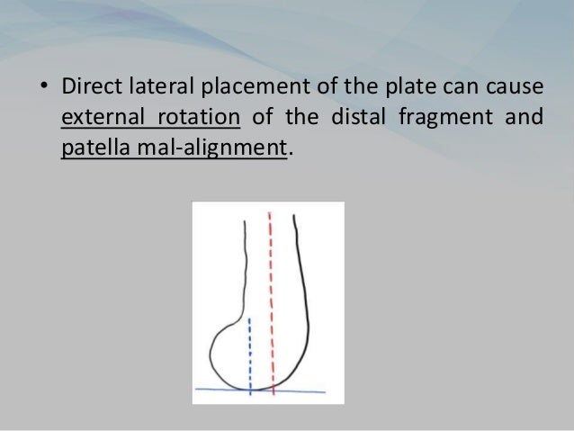 • Direct lateral placement of the plate can cause
external rotation of the distal fragment and
patella mal-alignment.
 