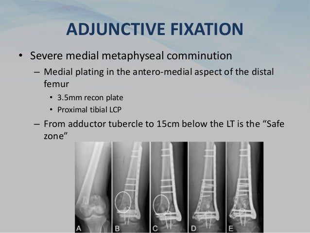 ADJUNCTIVE FIXATION
• Severe medial metaphyseal comminution
– Medial plating in the antero-medial aspect of the distal
femur
• 3.5mm recon plate
• Proximal tibial LCP
– From adductor tubercle to 15cm below the LT is the “Safe
zone”
 
