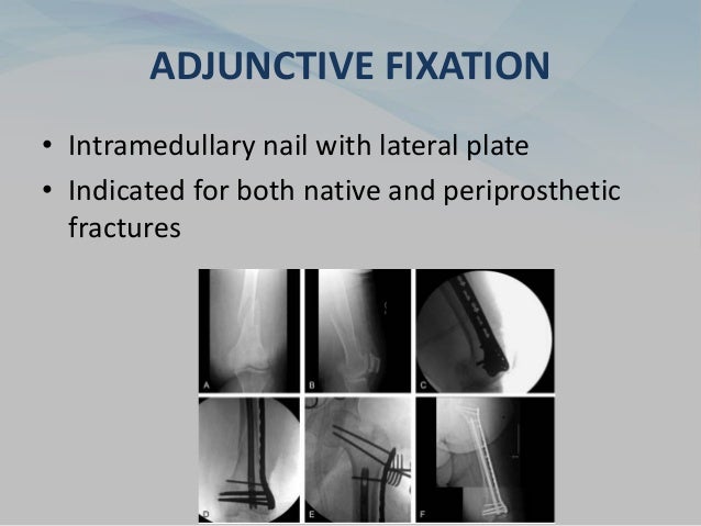 ADJUNCTIVE FIXATION
• Intramedullary nail with lateral plate
• Indicated for both native and periprosthetic
fractures
 
