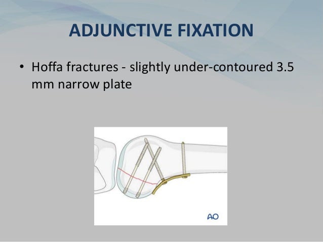 ADJUNCTIVE FIXATION
• Hoffa fractures - slightly under-contoured 3.5
mm narrow plate
 