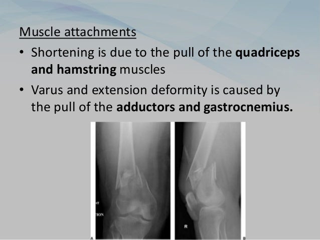 Muscle attachments
• Shortening is due to the pull of the quadriceps
and hamstring muscles
• Varus and extension deformity is caused by
the pull of the adductors and gastrocnemius.
 