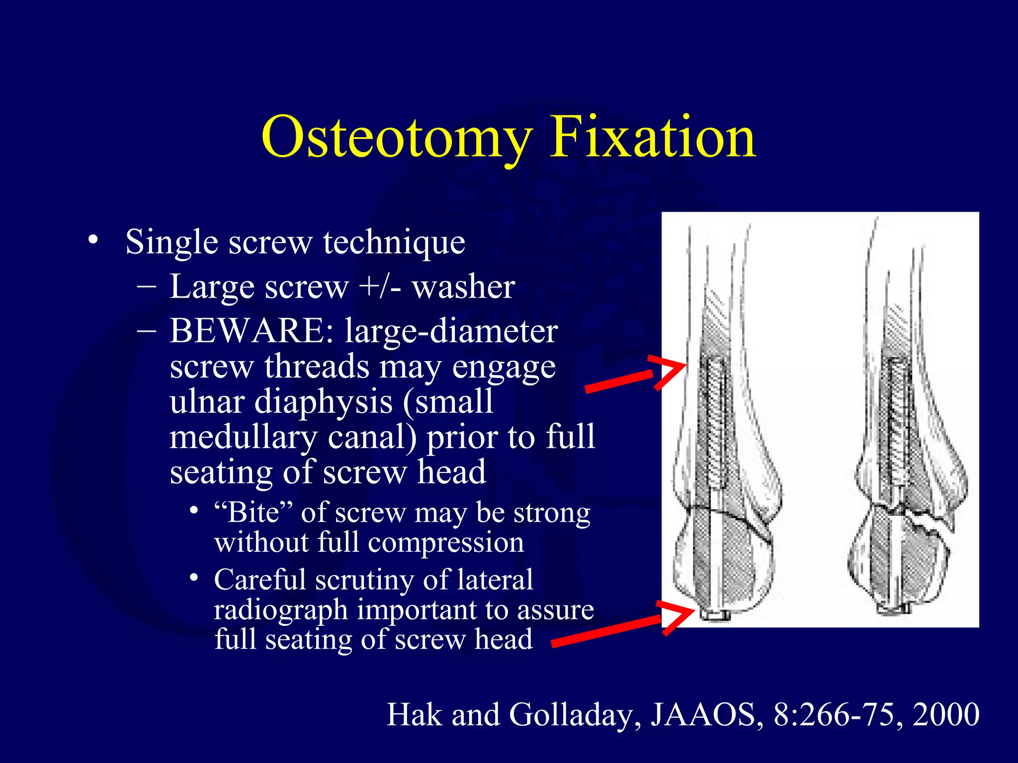 Osteotomy Fixation
• Single screw technique
   – Large screw +/- washer
   – BEWARE: large-diameter
     screw threads may engage
     ulnar diaphysis (small
     medullary canal) prior to full
     seating of screw head
      • “Bite” of screw may be strong
        without full compression
      • Careful scrutiny of lateral
        radiograph important to assure
        full seating of screw head

                     Hak and Golladay, JAAOS, 8:266-75, 2000
 