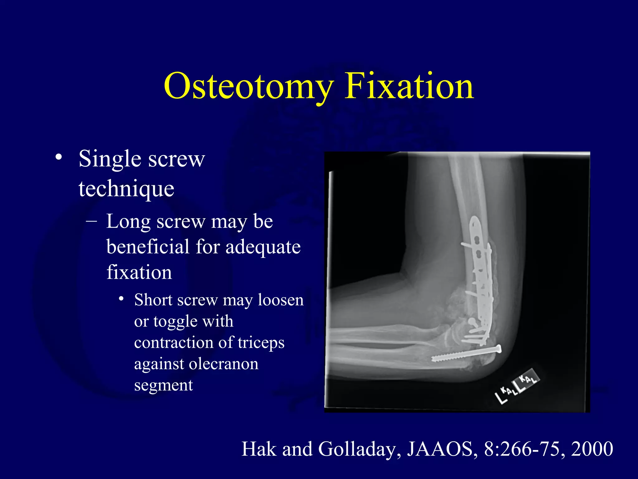 Osteotomy Fixation
• Single screw
  technique
  – Long screw may be
    beneficial for adequate
    fixation
     • Short screw may loosen
       or toggle with
       contraction of triceps
       against olecranon
       segment


                    Hak and Golladay, JAAOS, 8:266-75, 2000
 