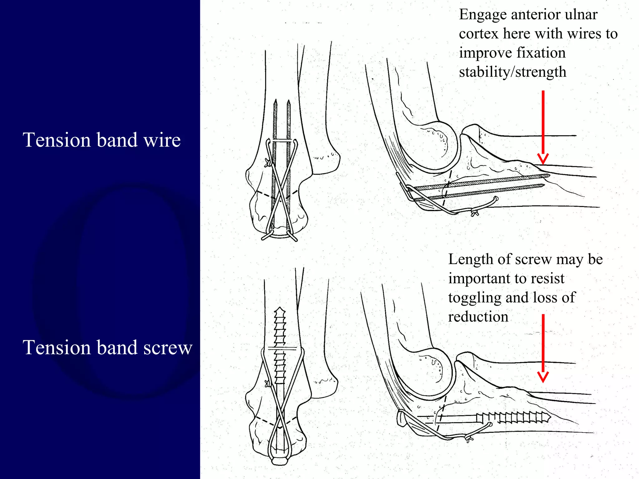 Engage anterior ulnar
                      cortex here with wires to
                      improve fixation
                      stability/strength



Tension band wire




                     Length of screw may be
                     important to resist
                     toggling and loss of
                     reduction

Tension band screw
 