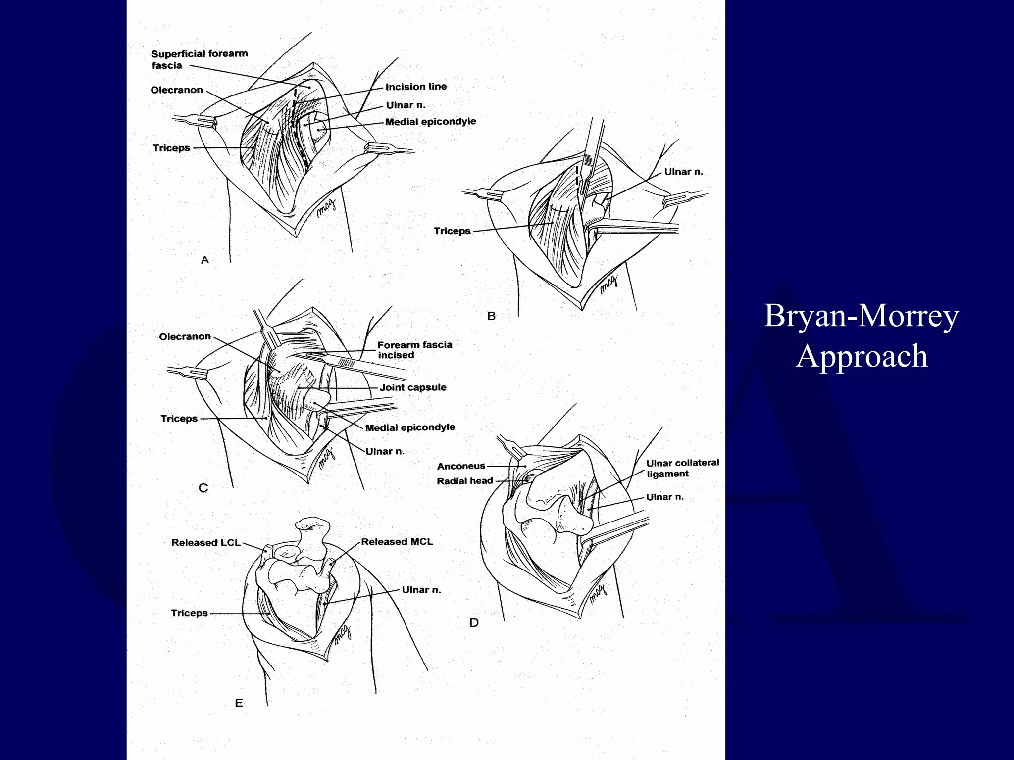 Bryan-Morrey
  Approach
 