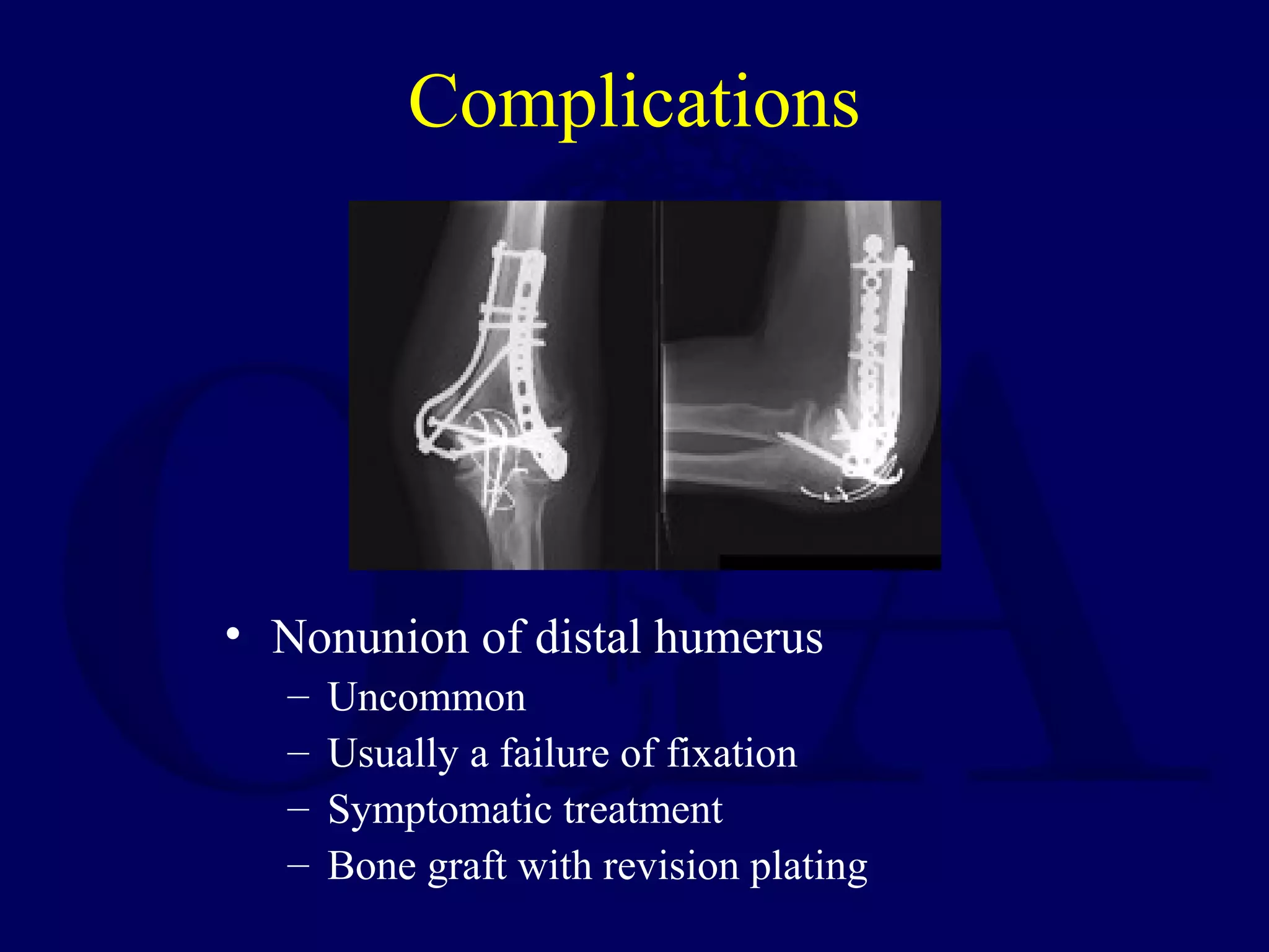 Complications




• Nonunion of distal humerus
  –   Uncommon
  –   Usually a failure of fixation
  –   Symptomatic treatment
  –   Bone graft with revision plating
 