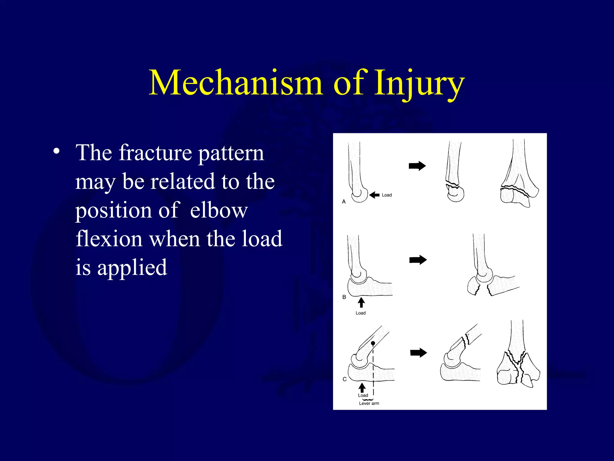 Mechanism of Injury
• The fracture pattern
  may be related to the
  position of elbow
  flexion when the load
  is applied
 