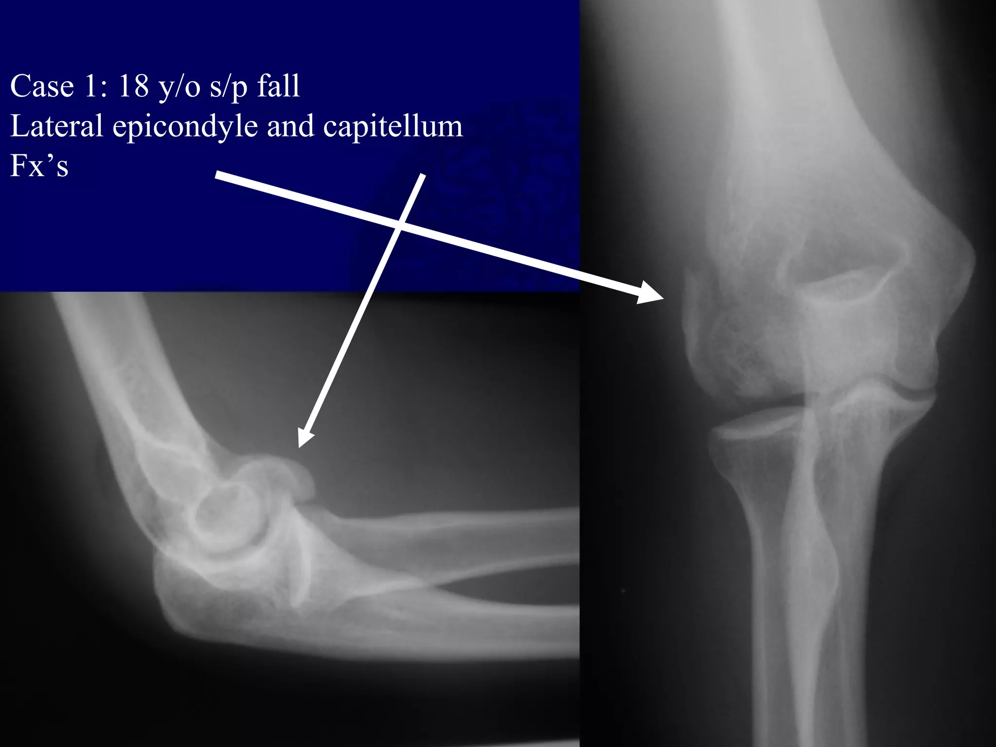 Case 1: 18 y/o s/p fall
Lateral epicondyle and capitellum
Fx’s
 