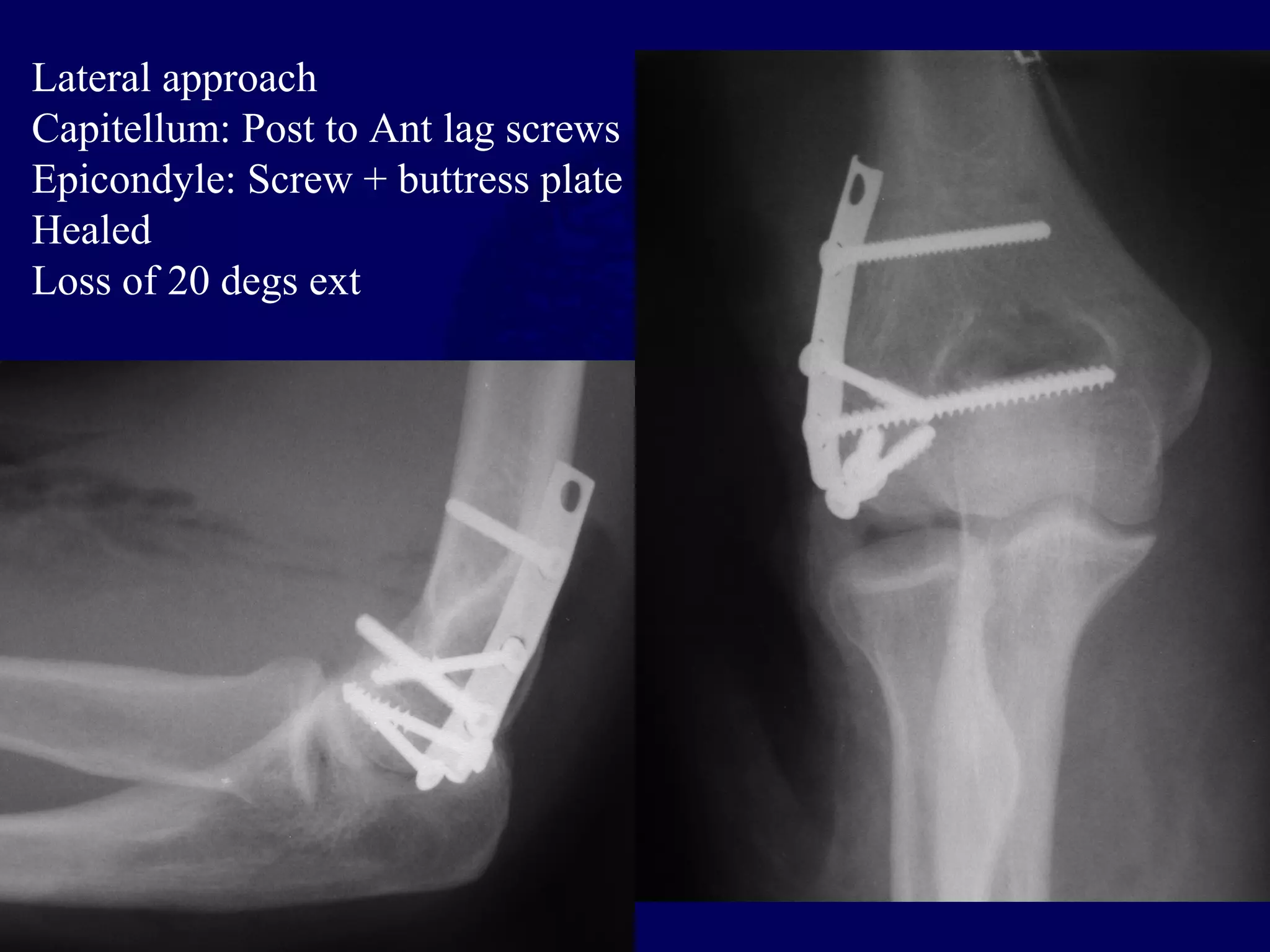 Lateral approach
Capitellum: Post to Ant lag screws
Epicondyle: Screw + buttress plate
Healed
Loss of 20 degs ext
 