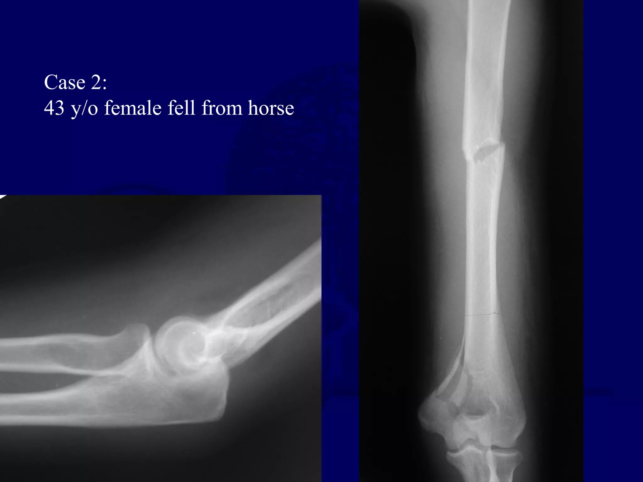 Case 2:
43 y/o female fell from horse
 