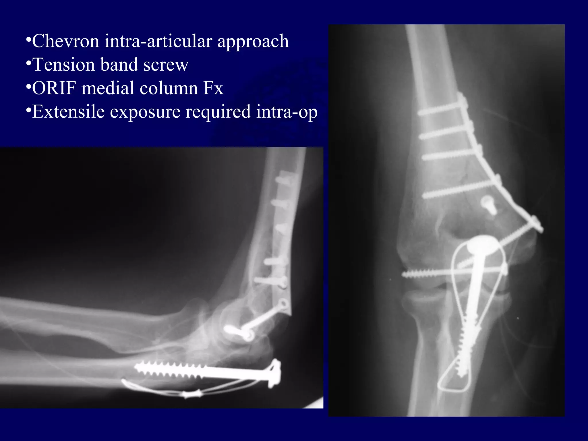 •Chevron intra-articular approach
•Tension band screw
•ORIF medial column Fx
•Extensile exposure required intra-op
 