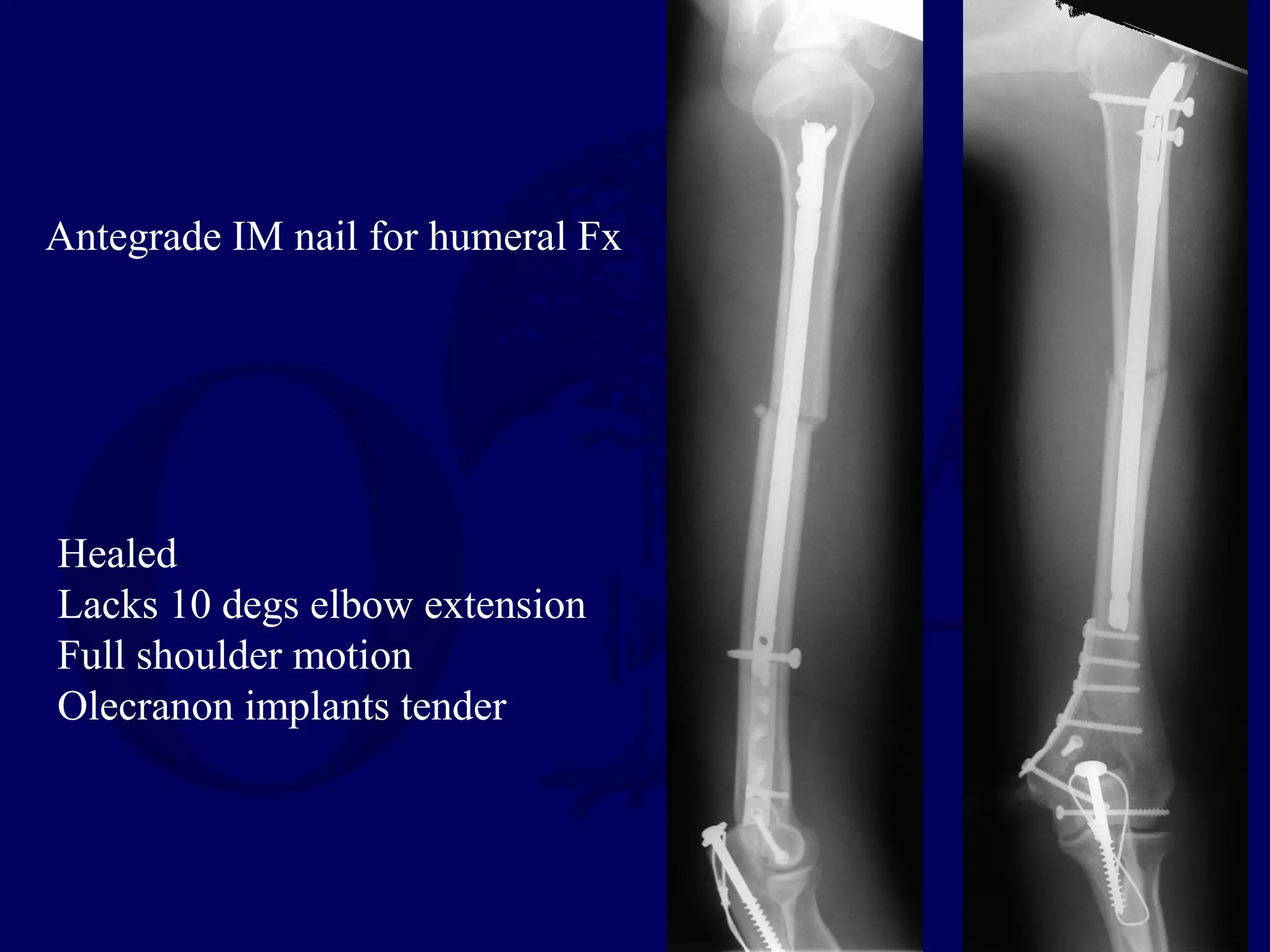 Antegrade IM nail for humeral Fx




Healed
Lacks 10 degs elbow extension
Full shoulder motion
Olecranon implants tender
 