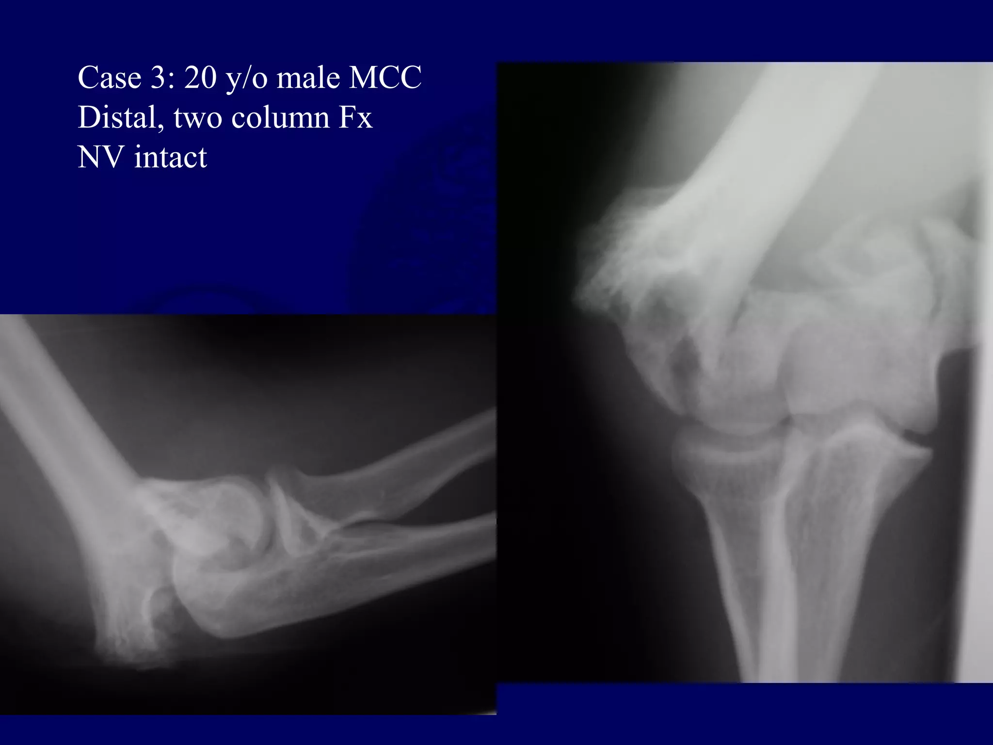 Case 3: 20 y/o male MCC
Distal, two column Fx
NV intact
 