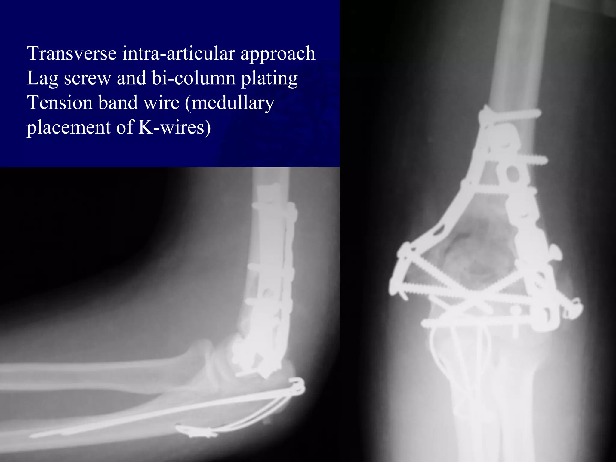 Transverse intra-articular approach
Lag screw and bi-column plating
Tension band wire (medullary
placement of K-wires)
 