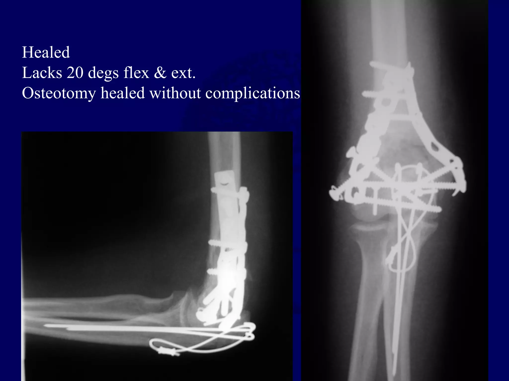 Healed
Lacks 20 degs flex & ext.
Osteotomy healed without complications
 