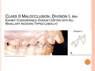Distal occlusion | PPTX