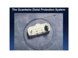 Guardwire Distal protection device | PPTX