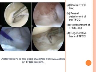 ARTHROSCOPY IS THE GOLD STANDARD FOR EVALUATION
OF TFCC INJURIES.
(a)Central TFCC
tear,
(b) Foveal
detachment of
the TFCC,
(c) Reattachment of
TFCC, and
(d) Degenerative
tears of TFCC.
 