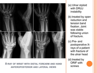 X-RAY OF WRIST WITH DISTAL FOREARM AND HAND
ANTEROPOSTERIOR AND LATERAL VIEWS
(a) Ulnar styloid
with DRUJ
instability
(b) treated by open
reduction and
tension band
fixation. Joint
was stable
following union
of fracture.
(c) Pre- and
postoperative X-
rays of a patient
with fracture of
the ulnar head
(d) treated by
ORIF with
screws
 