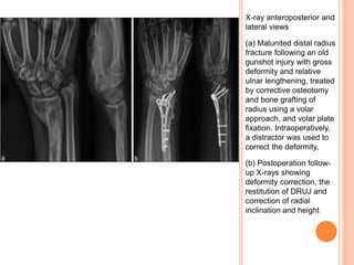 X-ray anteroposterior and
lateral views
(a) Malunited distal radius
fracture following an old
gunshot injury with gross
deformity and relative
ulnar lengthening, treated
by corrective osteotomy
and bone grafting of
radius using a volar
approach, and volar plate
fixation. Intraoperatively,
a distractor was used to
correct the deformity,
(b) Postoperation follow-
up X-rays showing
deformity correction, the
restitution of DRUJ and
correction of radial
inclination and height
 