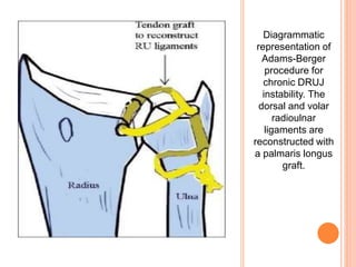 Diagrammatic
representation of
Adams-Berger
procedure for
chronic DRUJ
instability. The
dorsal and volar
radioulnar
ligaments are
reconstructed with
a palmaris longus
graft.
 