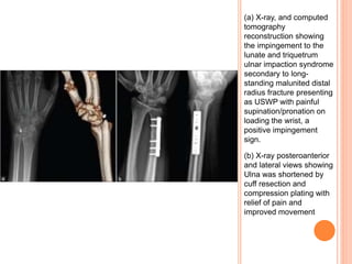 (a) X-ray, and computed
tomography
reconstruction showing
the impingement to the
lunate and triquetrum
ulnar impaction syndrome
secondary to long-
standing malunited distal
radius fracture presenting
as USWP with painful
supination/pronation on
loading the wrist, a
positive impingement
sign.
(b) X-ray posteroanterior
and lateral views showing
Ulna was shortened by
cuff resection and
compression plating with
relief of pain and
improved movement
 