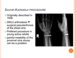 SAUVE-KAPANDJI PROCEDURE
 Originally described in
1936
 DRUJ arthrodesis +
surgical pseudarthrosis
of the distal ulna
 Prefered procedure in
young active adults
 painful instability of the
proximal ulna stump
can be a problem
 