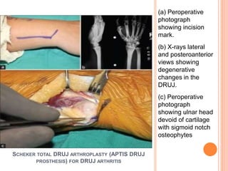 SCHEKER TOTAL DRUJ ARTHROPLASTY (APTIS DRUJ
PROSTHESIS) FOR DRUJ ARTHRITIS
(a) Peroperative
photograph
showing incision
mark.
(b) X-rays lateral
and posteroanterior
views showing
degenerative
changes in the
DRUJ.
(c) Peroperative
photograph
showing ulnar head
devoid of cartilage
with sigmoid notch
osteophytes
 