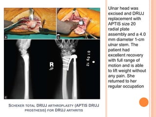 SCHEKER TOTAL DRUJ ARTHROPLASTY (APTIS DRUJ
PROSTHESIS) FOR DRUJ ARTHRITIS
Ulnar head was
excised and DRUJ
replacement with
APTIS size 20
radial plate
assembly and a 4.0
mm diameter 1-cm
ulnar stem. The
patient had
excellent recovery
with full range of
motion and is able
to lift weight without
any pain. She
returned to her
regular occupation
 