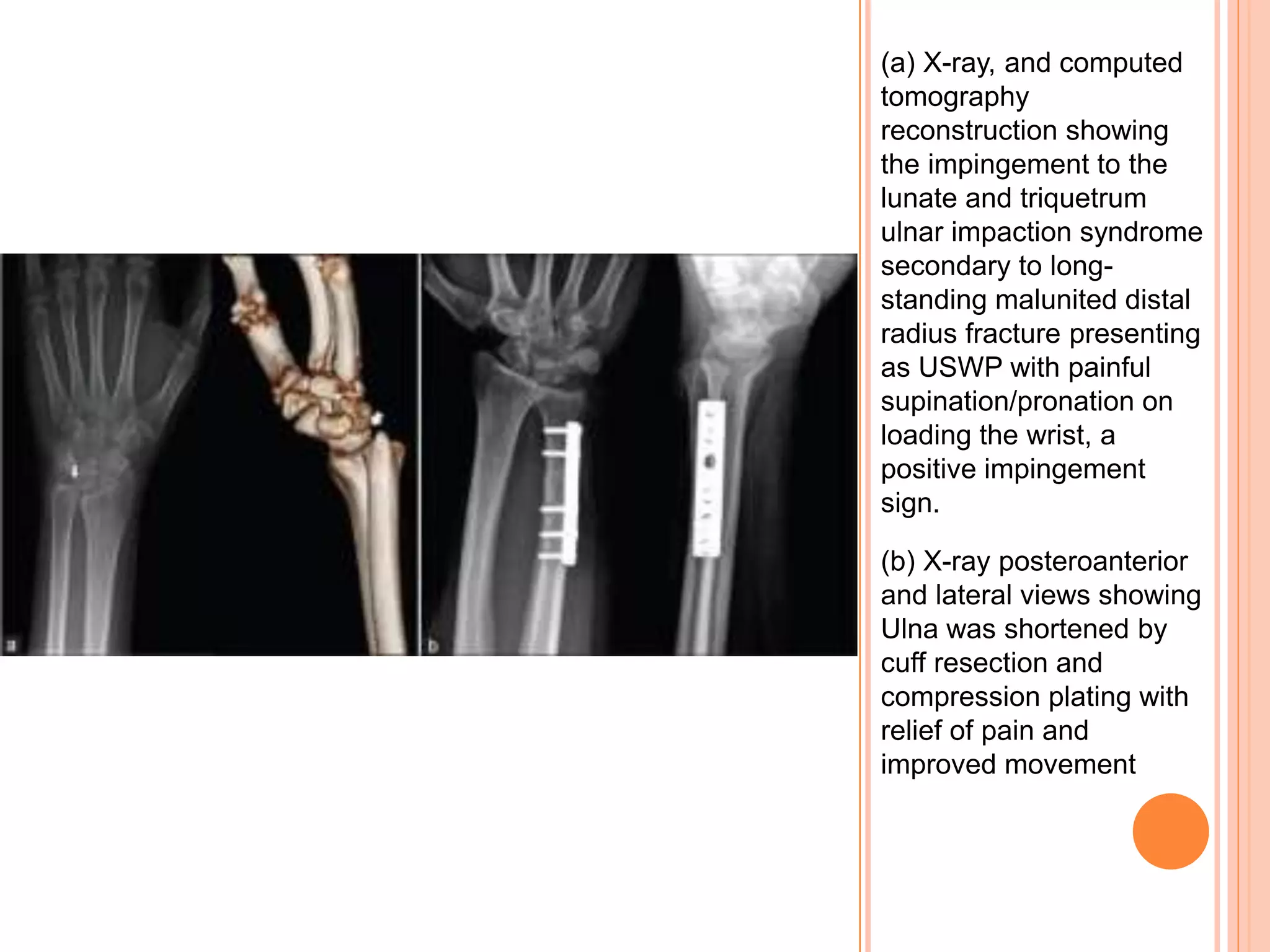 Distal radioulnar joint injuries | PPTX