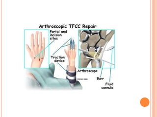 Distal radioulnar joint injuries( DRUJ) and carpal instability | PPTX