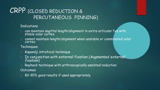 Ray Hack Distal Radius.Fractures | PPTX