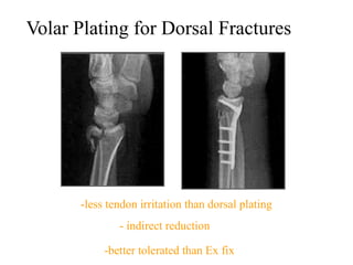 Distal radius fracture | PPT