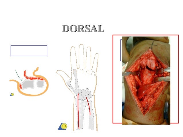 distal radius fracture