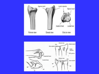 Distal Radius Fractures- Powerpoint presentation | PPTX