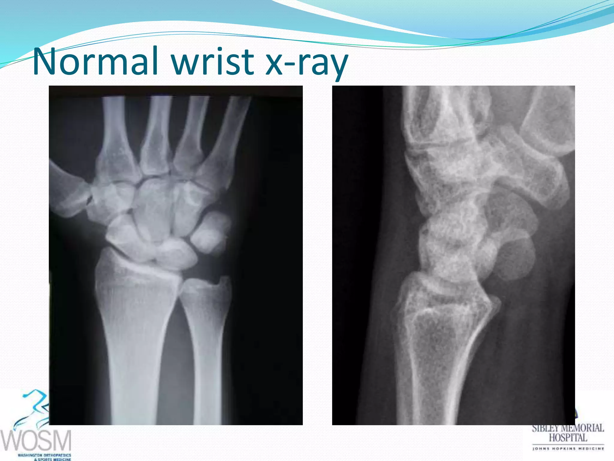 Normal wrist x-ray