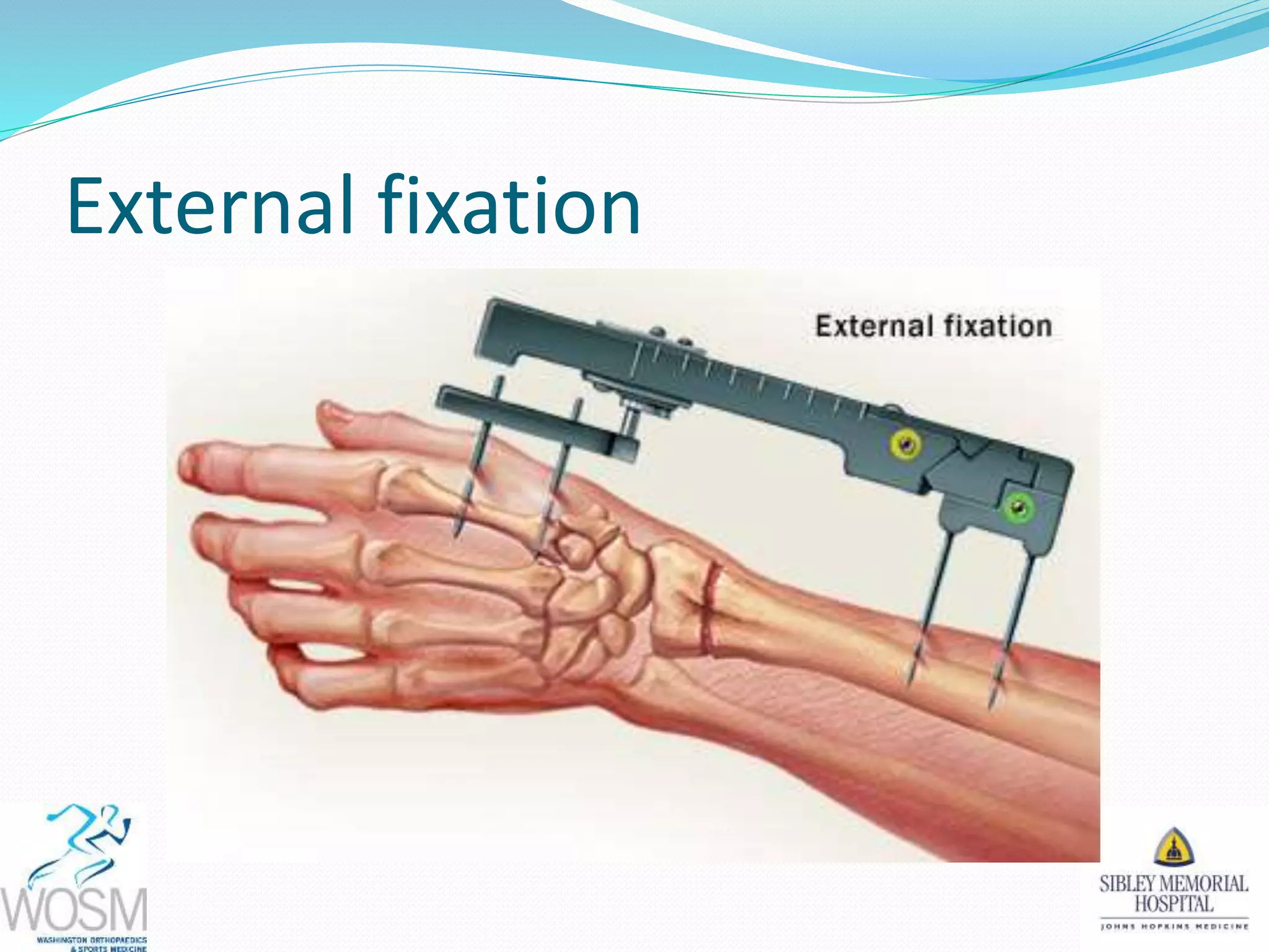 External fixation