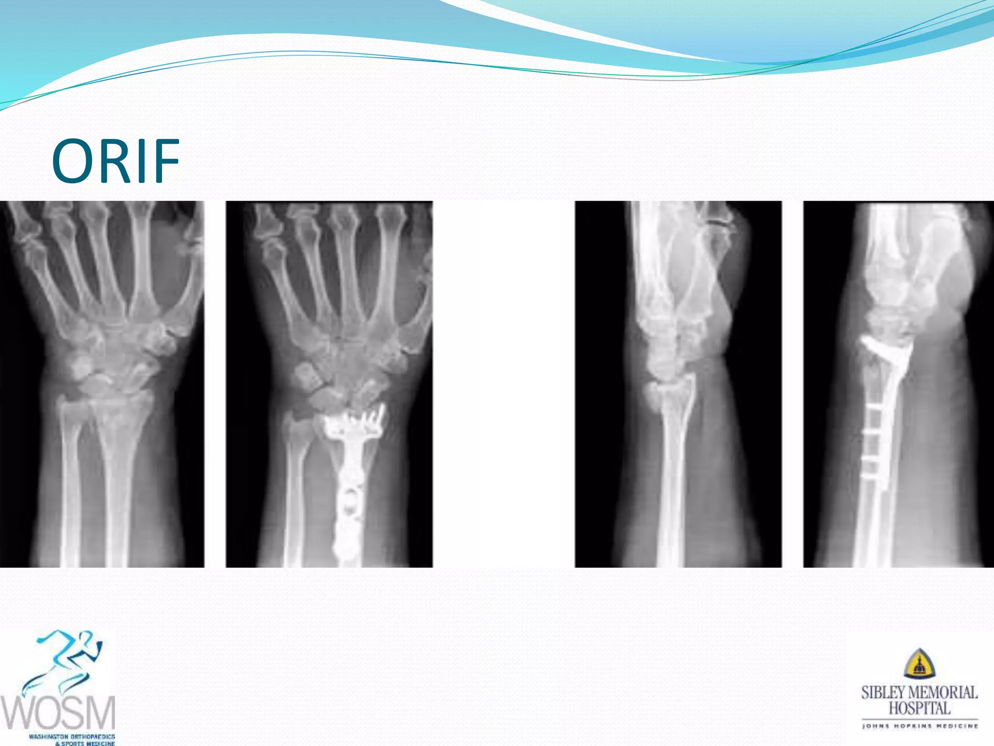 ORIF