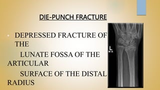 DIE-PUNCH FRACTURE
• DEPRESSED FRACTURE OF
THE
LUNATE FOSSA OF THE
ARTICULAR
SURFACE OF THE DISTAL
RADIUS
 