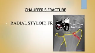CHAUFFER’S FRACTURE
• RADIAL STYLOID FRACTURE
 