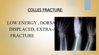 COLLES FRACTURE:
• LOW ENERGY , DORSALLY
DISPLACED, EXTRA-ARTICULAR
FRACTURE
 