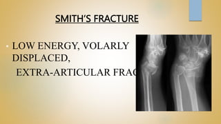 SMITH’S FRACTURE
• LOW ENERGY, VOLARLY
DISPLACED,
EXTRA-ARTICULAR FRACTURE
 