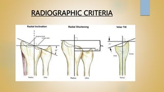 RADIOGRAPHIC CRITERIA
 