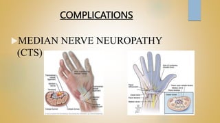 COMPLICATIONS
MEDIAN NERVE NEUROPATHY
(CTS)
 