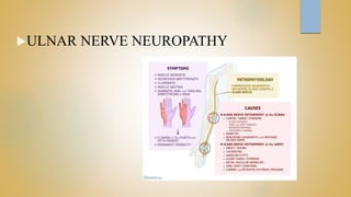 ULNAR NERVE NEUROPATHY
 